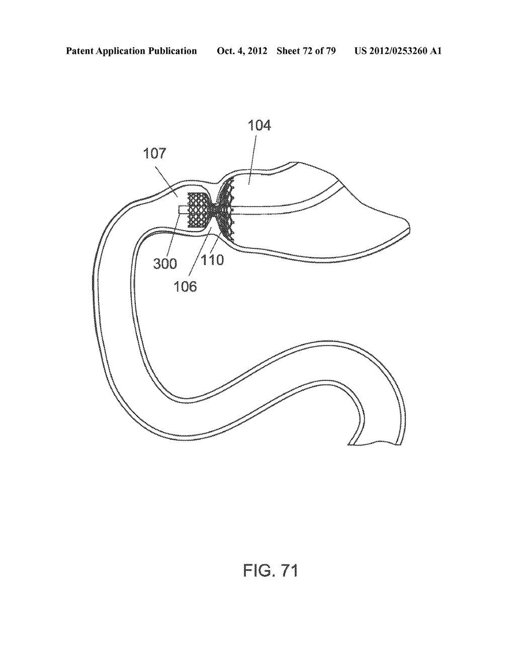 GASTROINTESTINAL PROSTHESES - diagram, schematic, and image 73