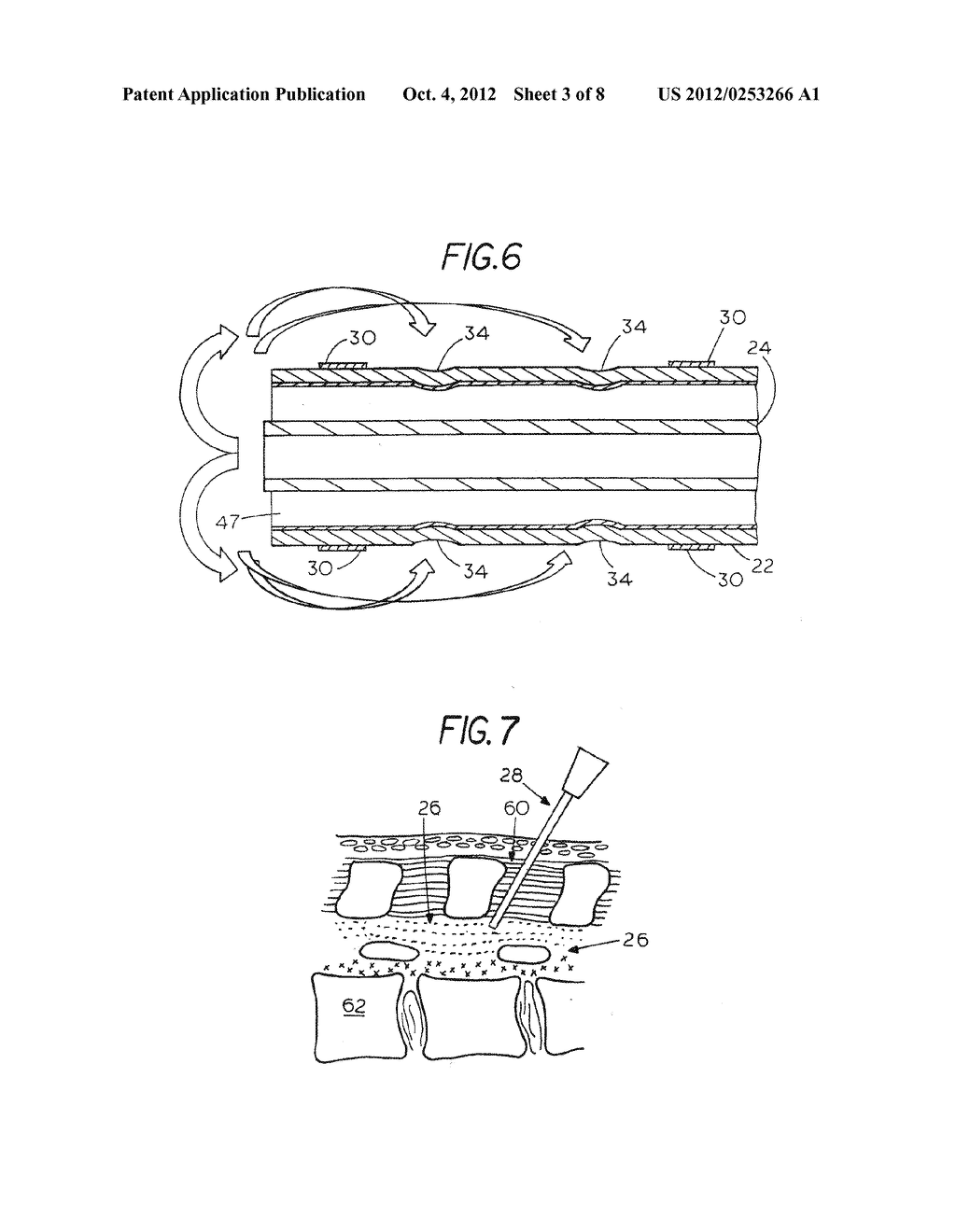 Extradural Infusion Suction System and Method to Drain Fluid Collection in     the Extradural Space of Spinal Cord - diagram, schematic, and image 04