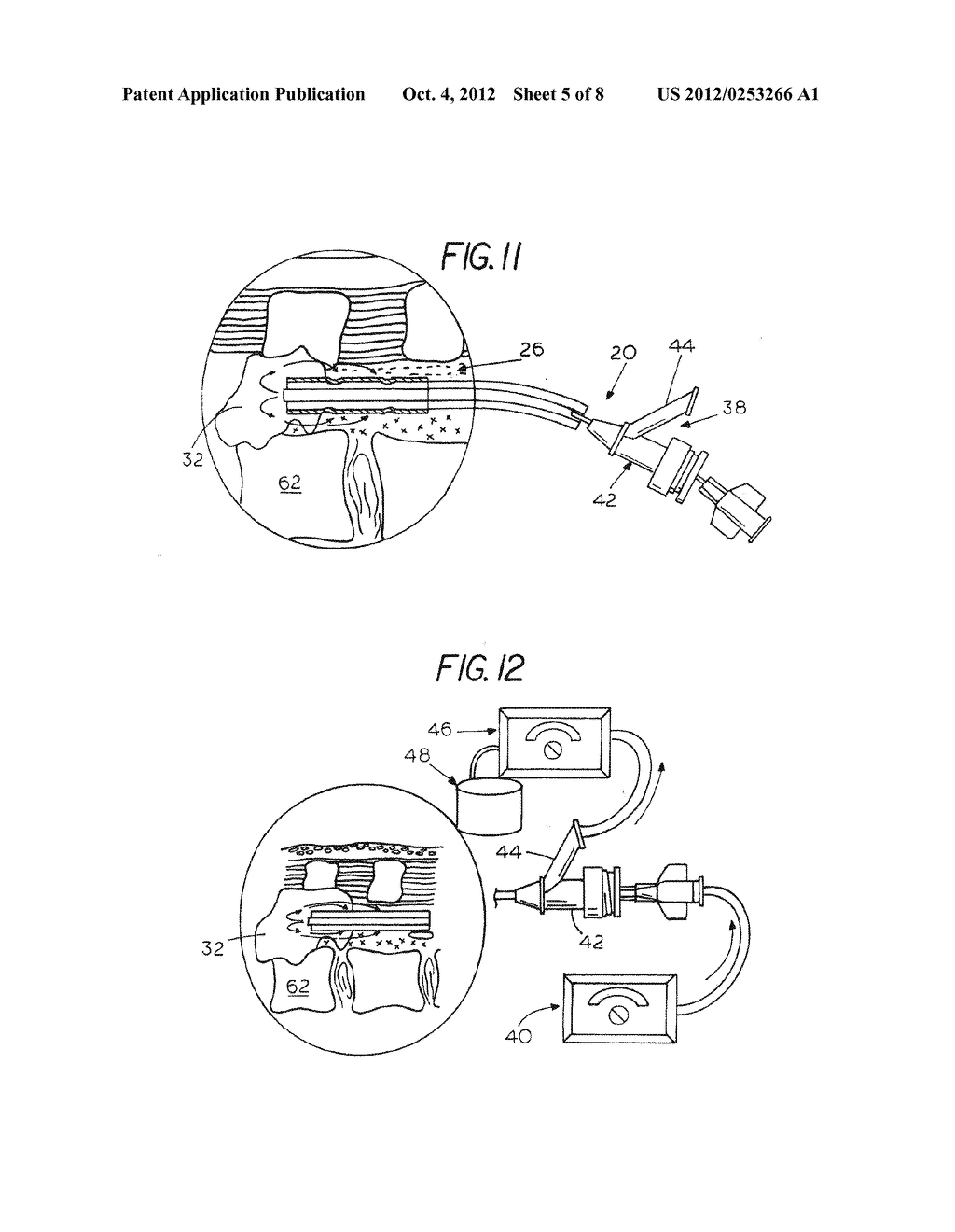 Extradural Infusion Suction System and Method to Drain Fluid Collection in     the Extradural Space of Spinal Cord - diagram, schematic, and image 06