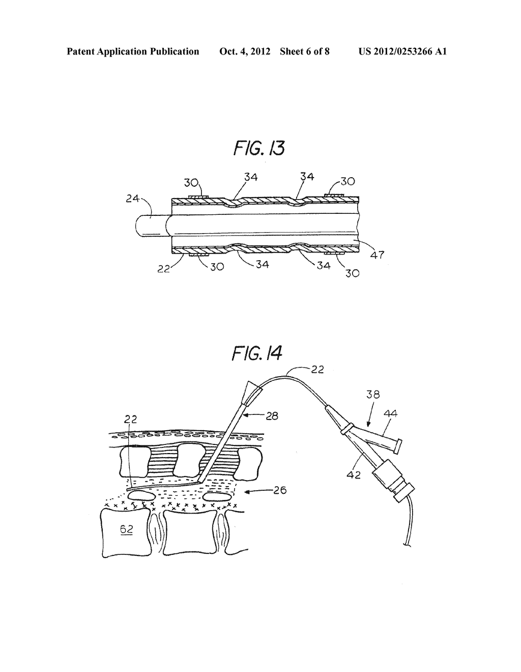 Extradural Infusion Suction System and Method to Drain Fluid Collection in     the Extradural Space of Spinal Cord - diagram, schematic, and image 07