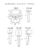 Extradural Infusion Suction System and Method to Drain Fluid Collection in     the Extradural Space of Spinal Cord diagram and image