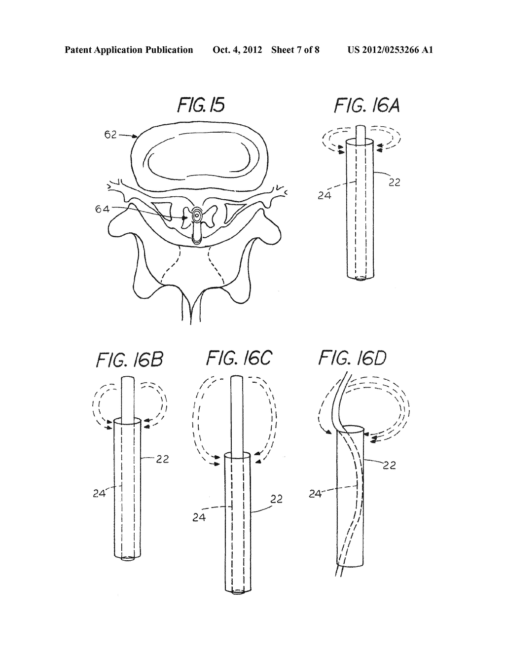 Extradural Infusion Suction System and Method to Drain Fluid Collection in     the Extradural Space of Spinal Cord - diagram, schematic, and image 08