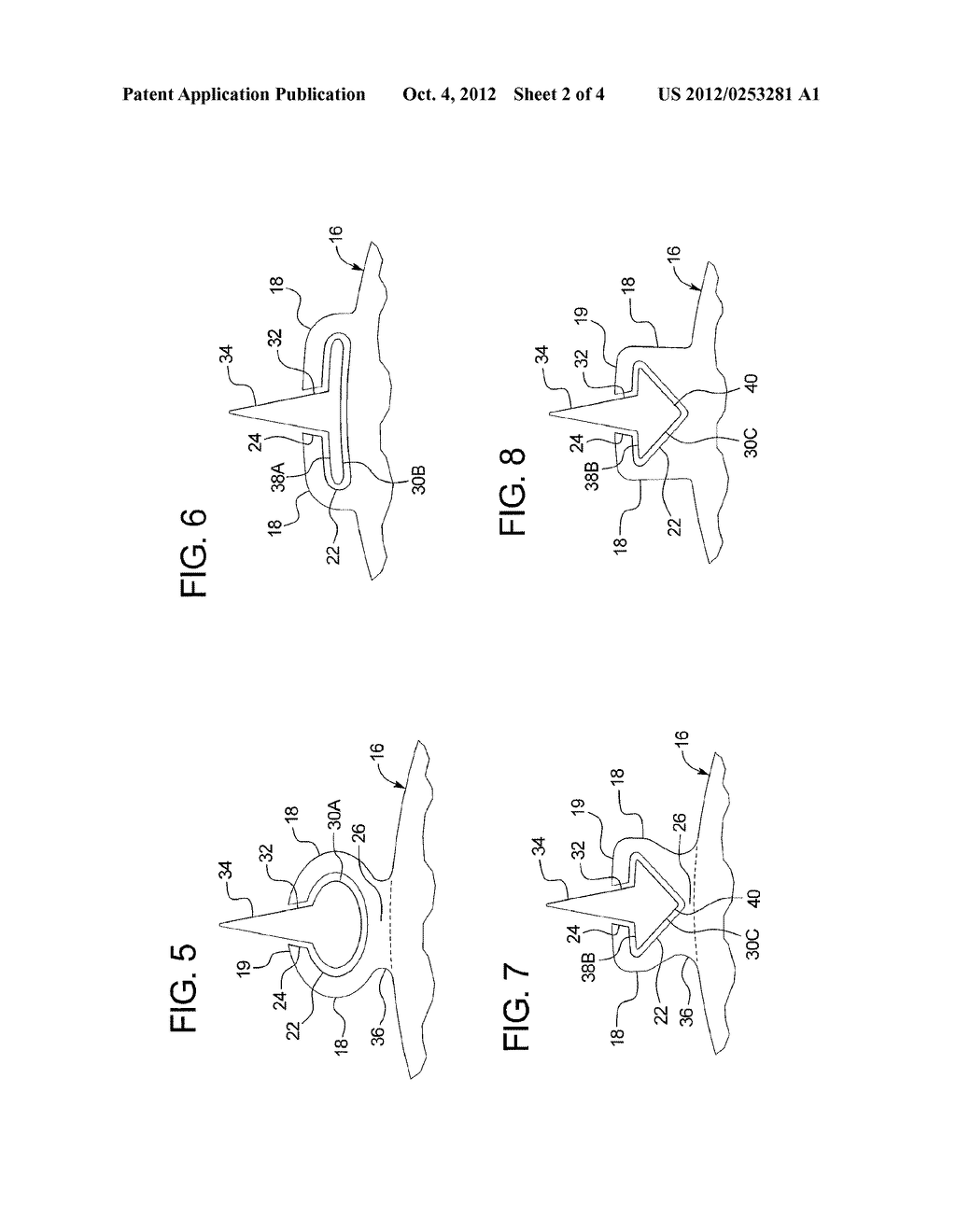 BALLOON WITH INTEGRAL RETENTION OF A DILATION ELEMENT - diagram, schematic, and image 03