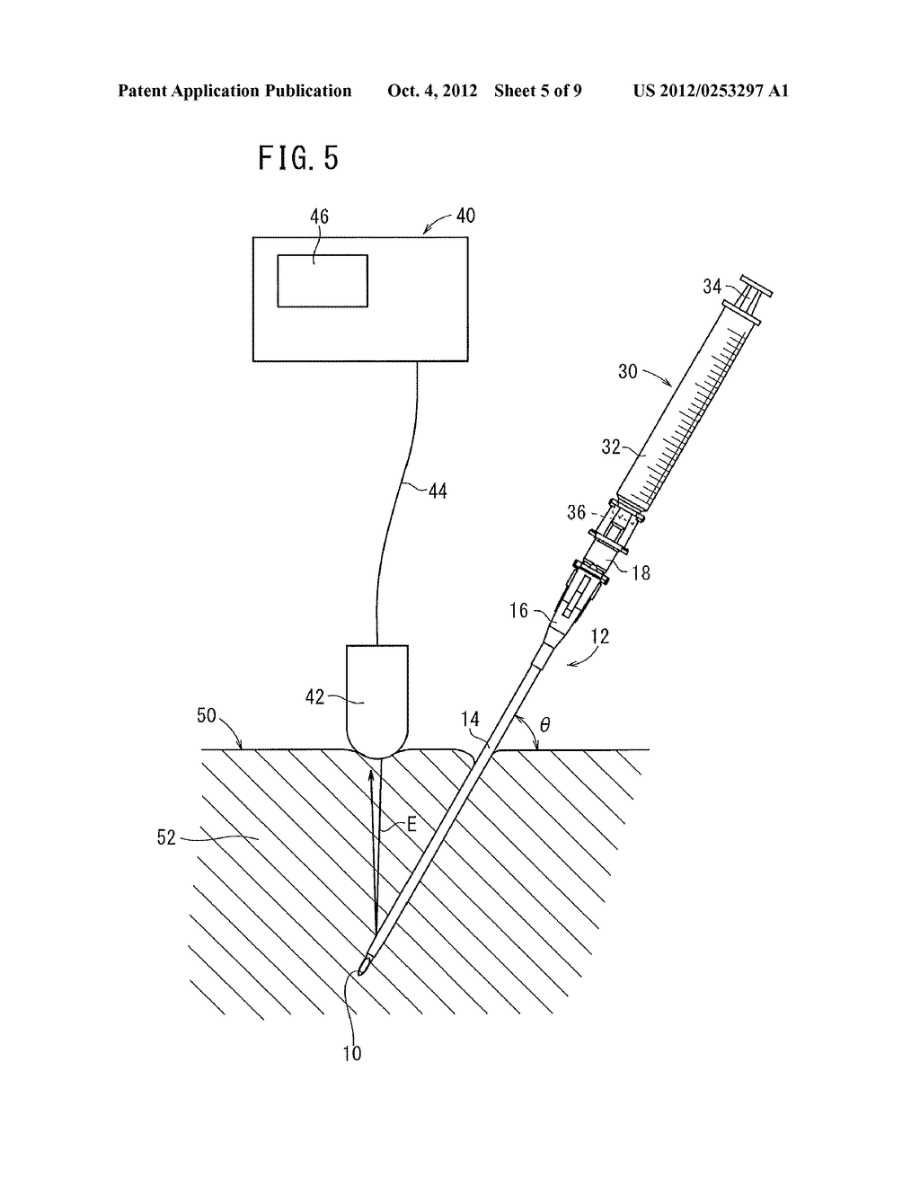 ULTRASOUND-GUIDED PIERCING NEEDLE AND INDWELLING NEEDLE - diagram, schematic, and image 06