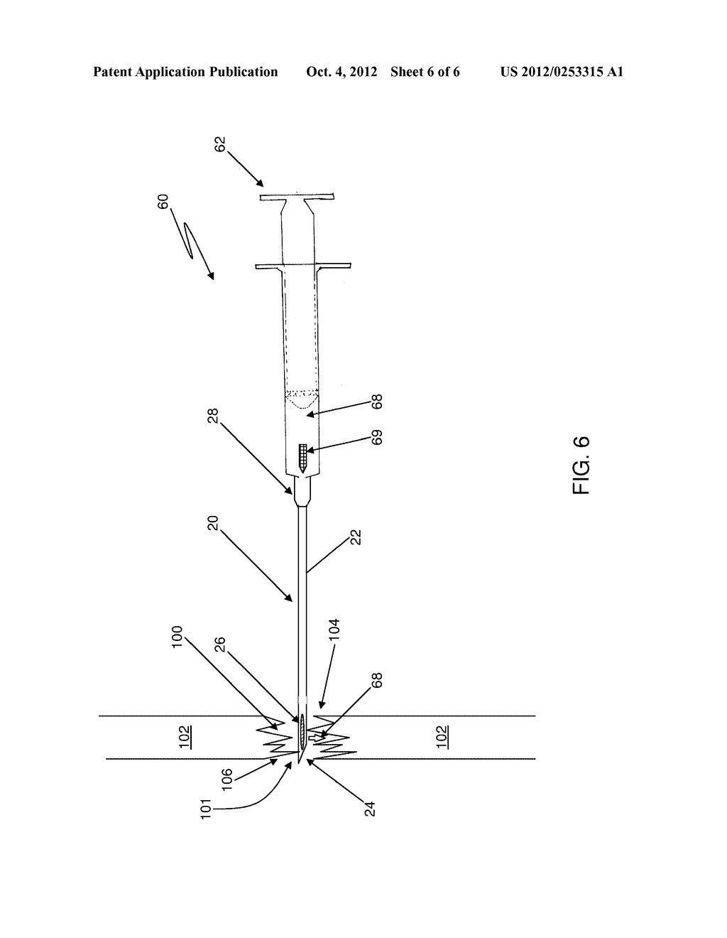 INJECTION NEEDLE FOR FRACTURES - diagram, schematic, and image 07