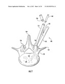 PERCUTANEOUS BIOLOGIC DELIVERY SYSTEM diagram and image