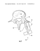 PERCUTANEOUS BIOLOGIC DELIVERY SYSTEM diagram and image