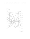 GUIDE WIRE FIXATION diagram and image