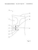 GUIDE WIRE FIXATION diagram and image