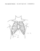 SURGERY METHODS USING A ROBOTIC INSTRUMENT SYSTEM diagram and image