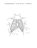 SURGERY METHODS USING A ROBOTIC INSTRUMENT SYSTEM diagram and image