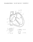 SURGERY METHODS USING A ROBOTIC INSTRUMENT SYSTEM diagram and image