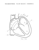 SURGERY METHODS USING A ROBOTIC INSTRUMENT SYSTEM diagram and image