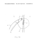 SURGERY METHODS USING A ROBOTIC INSTRUMENT SYSTEM diagram and image