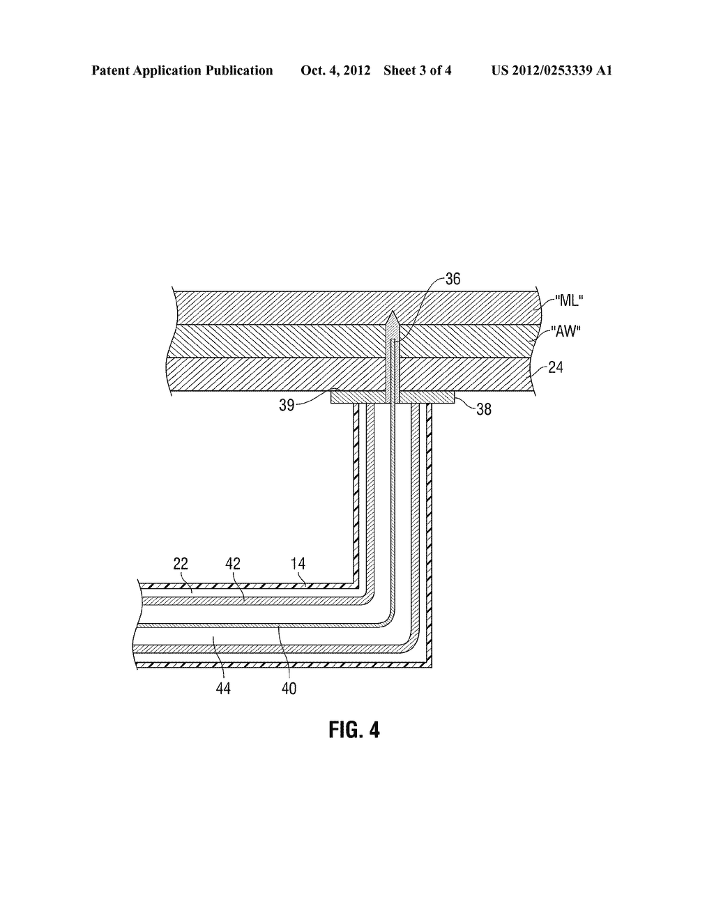 RADIO FREQUENCY-BASED SURGICAL IMPLANT FIXATION APPARATUS - diagram, schematic, and image 04