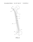 Three-Dimension-Extending Intramedullary Nail diagram and image