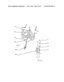 FRACTURING CALCIFICATIONS IN HEART VALVES diagram and image