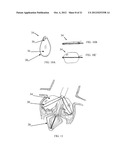 FRACTURING CALCIFICATIONS IN HEART VALVES diagram and image