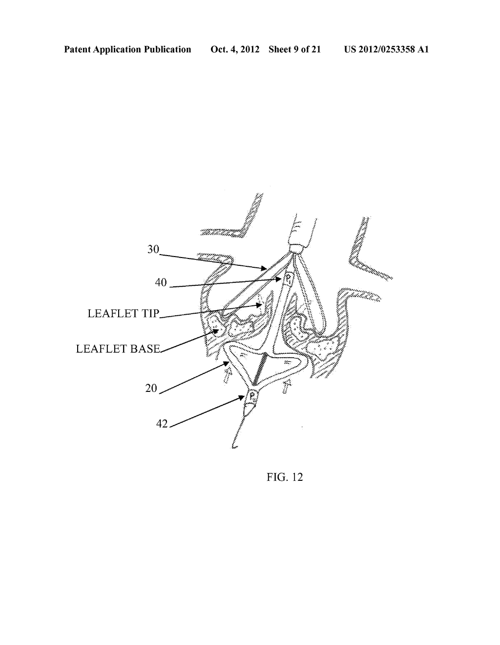 FRACTURING CALCIFICATIONS IN HEART VALVES - diagram, schematic, and image 10