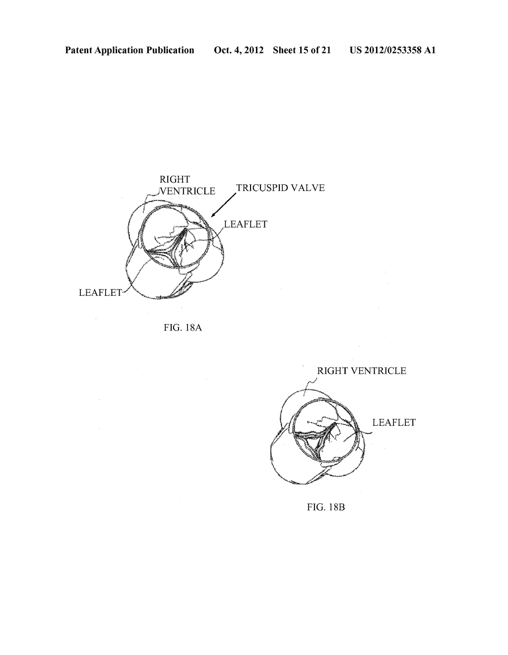 FRACTURING CALCIFICATIONS IN HEART VALVES - diagram, schematic, and image 16