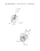 FRACTURING CALCIFICATIONS IN HEART VALVES diagram and image