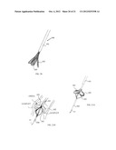 FRACTURING CALCIFICATIONS IN HEART VALVES diagram and image