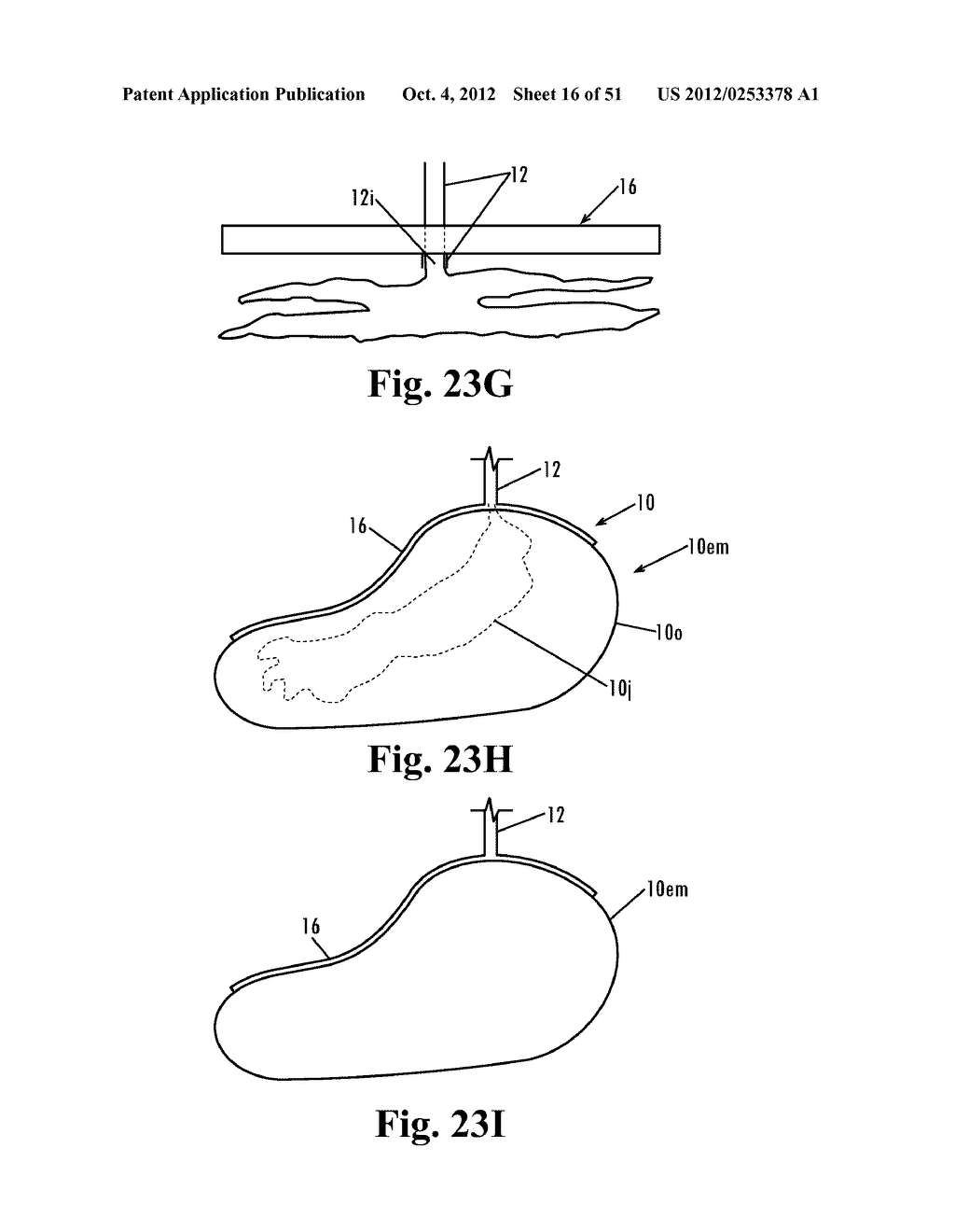 Devices and Methods for Treatment of Obesity - diagram, schematic, and image 17