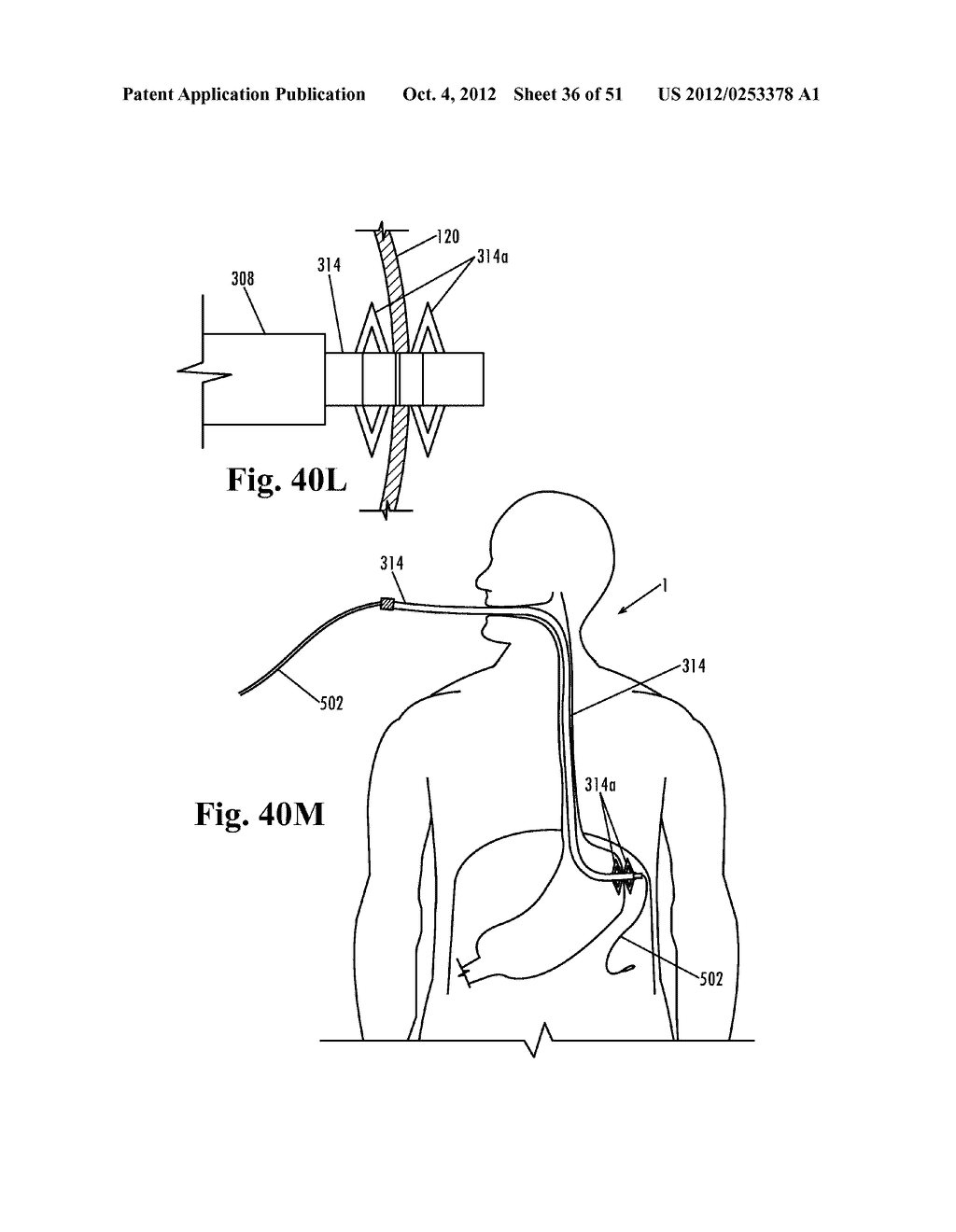 Devices and Methods for Treatment of Obesity - diagram, schematic, and image 37