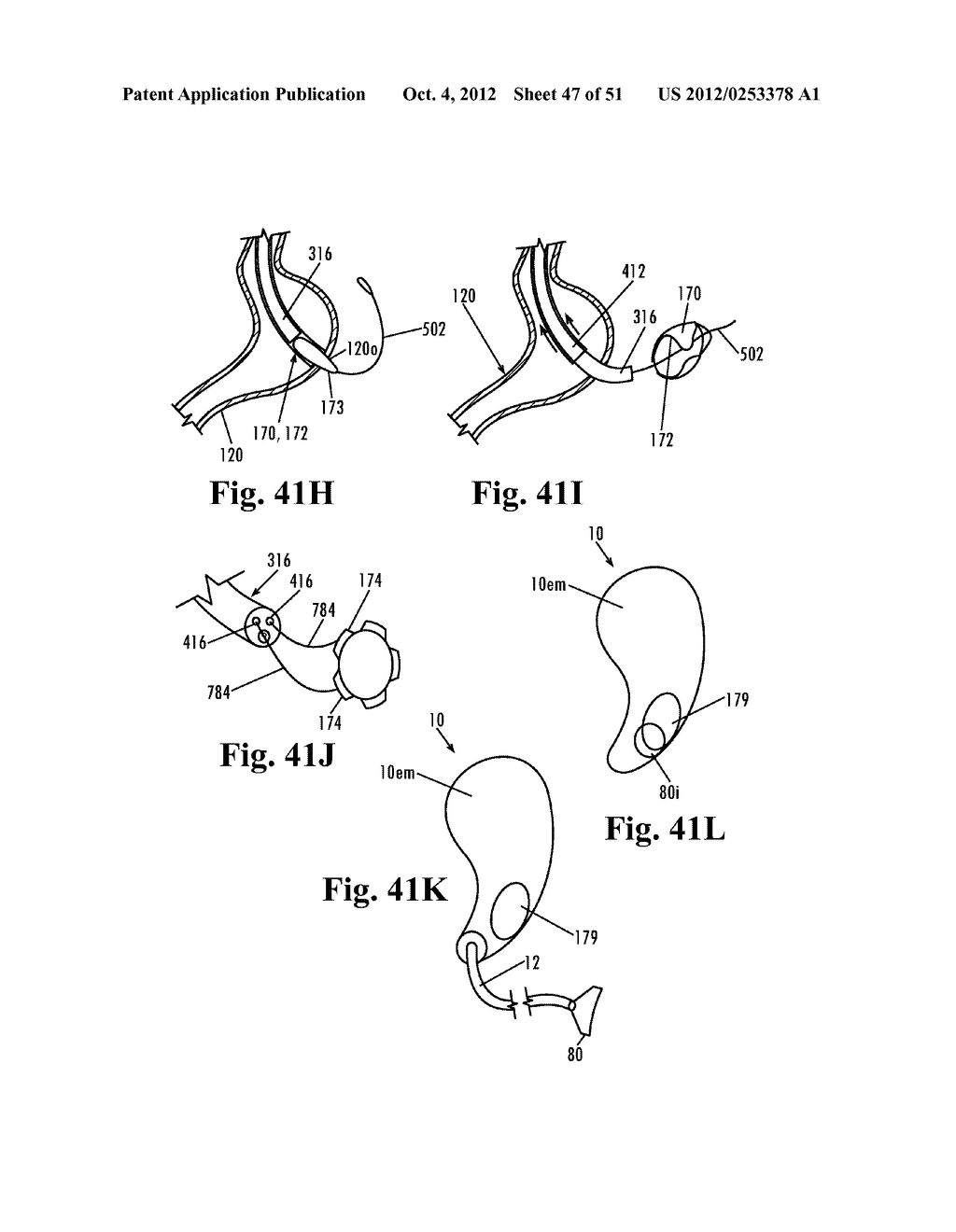 Devices and Methods for Treatment of Obesity - diagram, schematic, and image 48