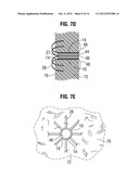 APICAL PUNCTURE ACCESS AND CLOSURE SYSTEM diagram and image