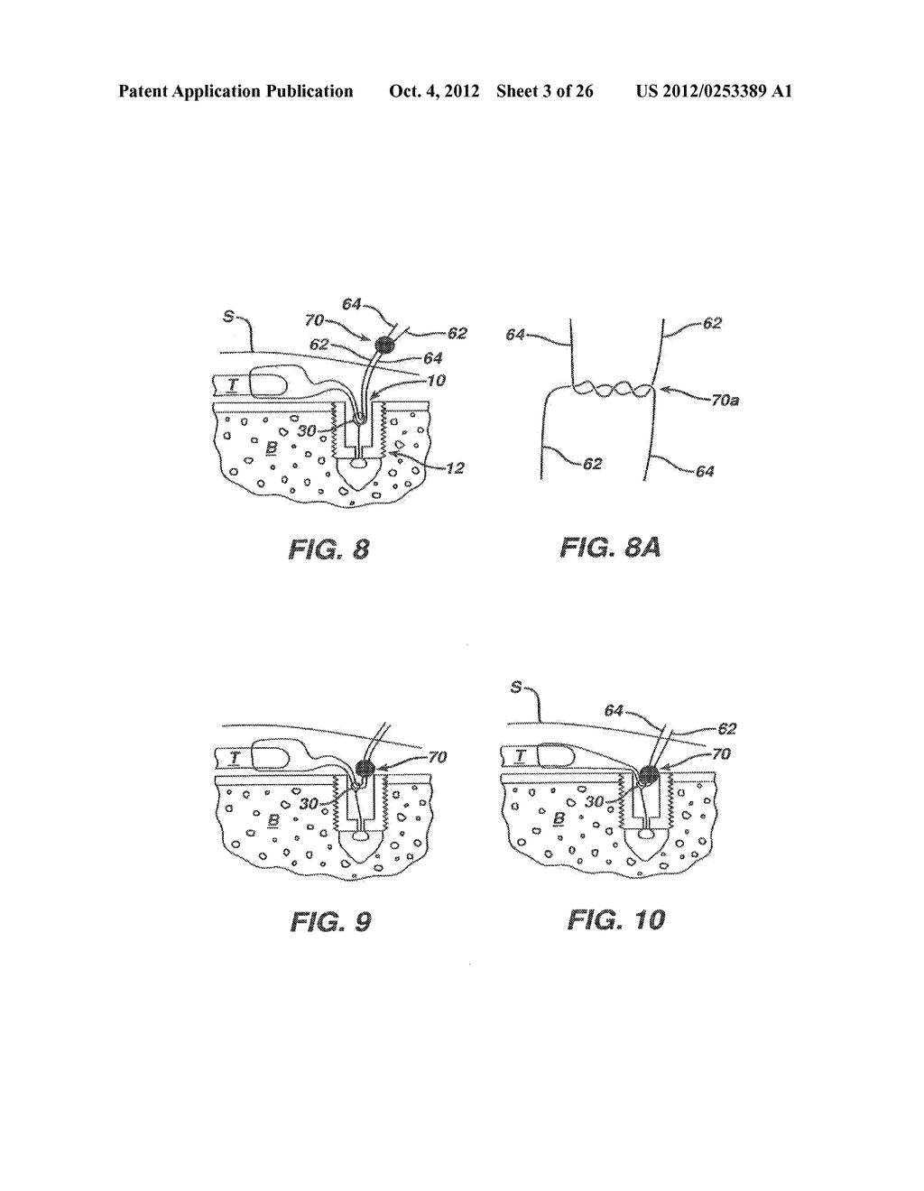 SURGICAL FILAMENT SNARE ASSEMBLIES - diagram, schematic, and image 04