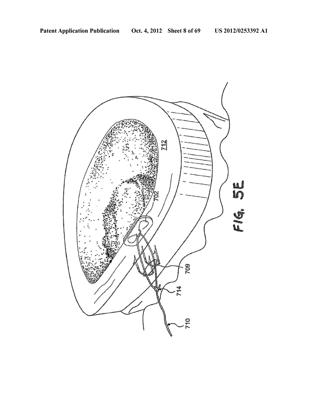 METHOD AND APPARATUS FOR THE TREATMENT OF TISSUE - diagram, schematic, and image 09