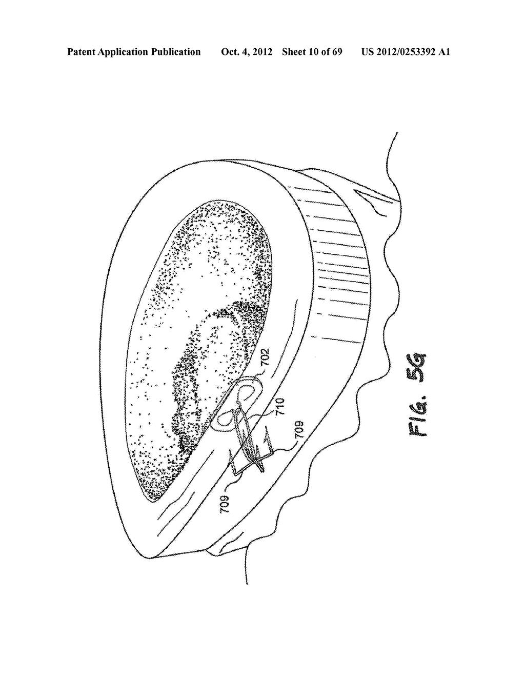 METHOD AND APPARATUS FOR THE TREATMENT OF TISSUE - diagram, schematic, and image 11