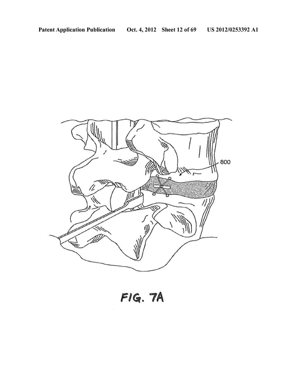 METHOD AND APPARATUS FOR THE TREATMENT OF TISSUE - diagram, schematic, and image 13