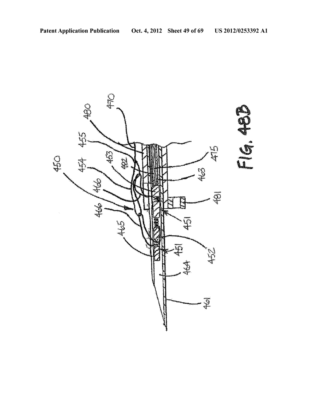 METHOD AND APPARATUS FOR THE TREATMENT OF TISSUE - diagram, schematic, and image 50