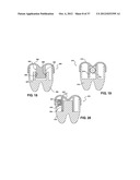 TWO PIECE SPINAL JACK INCORPORATING VARYING MECHANICAL AND FLUIDIC LIFT     MECHANISMS FOR ESTABLISHING A DESIRED SPACING BETWEEN SUCCEEDING     VERTEBRAE diagram and image