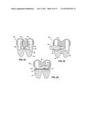 TWO PIECE SPINAL JACK INCORPORATING VARYING MECHANICAL AND FLUIDIC LIFT     MECHANISMS FOR ESTABLISHING A DESIRED SPACING BETWEEN SUCCEEDING     VERTEBRAE diagram and image