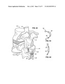 TWO PIECE SPINAL JACK INCORPORATING VARYING MECHANICAL AND FLUIDIC LIFT     MECHANISMS FOR ESTABLISHING A DESIRED SPACING BETWEEN SUCCEEDING     VERTEBRAE diagram and image