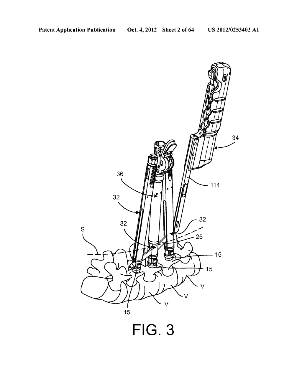 PEDICLE SCREW EXTENSION FOR USE IN PERCUTANEOUS SPINAL FIXATION - diagram, schematic, and image 03