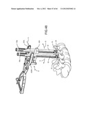 PEDICLE SCREW EXTENSION FOR USE IN PERCUTANEOUS SPINAL FIXATION diagram and image