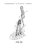 PEDICLE SCREW EXTENSION FOR USE IN PERCUTANEOUS SPINAL FIXATION diagram and image