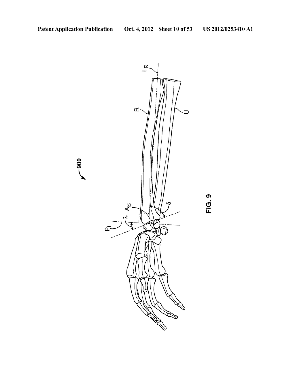 APPARATUS AND METHODS FOR BONE REPAIR PREPARATION - diagram, schematic, and image 11