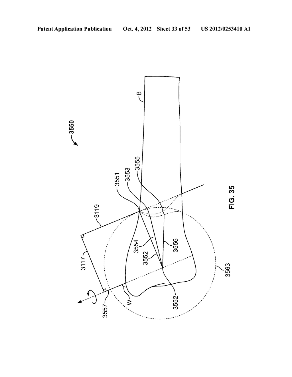 APPARATUS AND METHODS FOR BONE REPAIR PREPARATION - diagram, schematic, and image 34