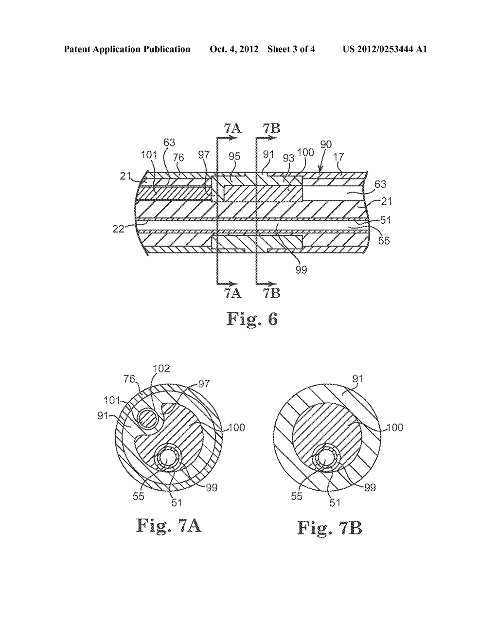 IMPLANTABLE MEDICAL LEAD HAVING REDUCED DIMENSION TUBING TRANSITION - diagram, schematic, and image 04