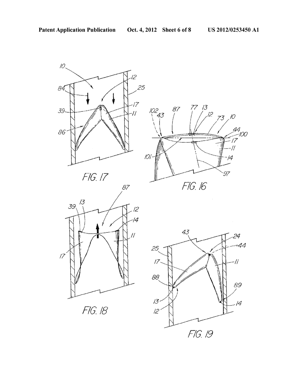 Prosthesis Adapted for Placement Under External Imaging - diagram, schematic, and image 07