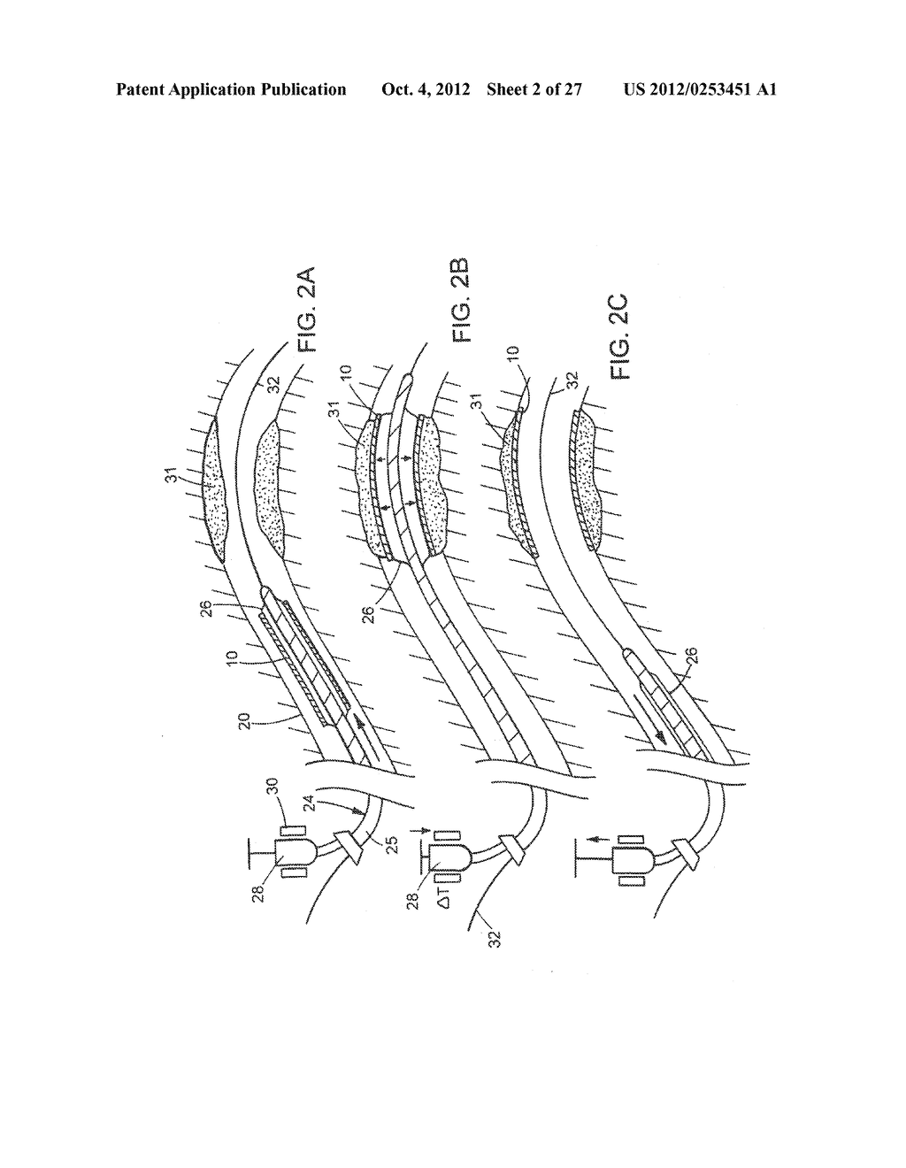 IMPLANTABLE MEDICAL DEVICES - diagram, schematic, and image 03