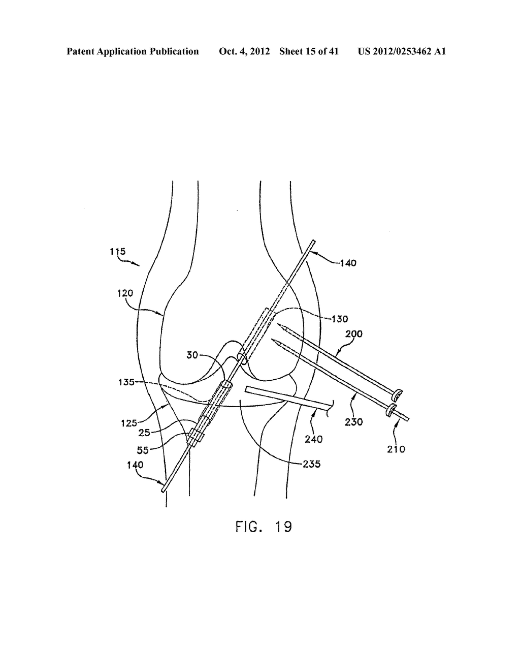 METHOD AND APPARATUS FOR FIXING A GRAFT IN A BONE TUNNEL - diagram, schematic, and image 16