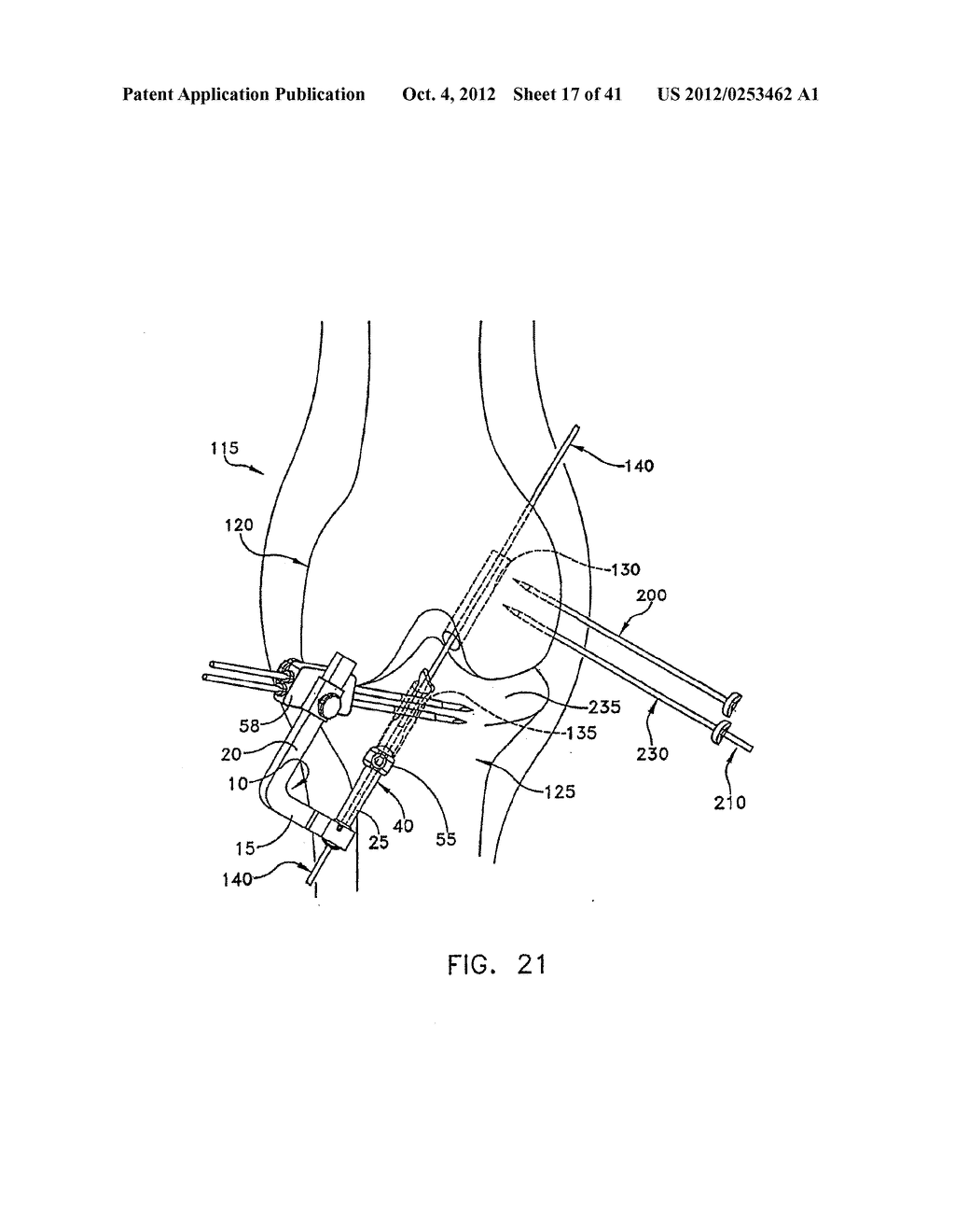 METHOD AND APPARATUS FOR FIXING A GRAFT IN A BONE TUNNEL - diagram, schematic, and image 18