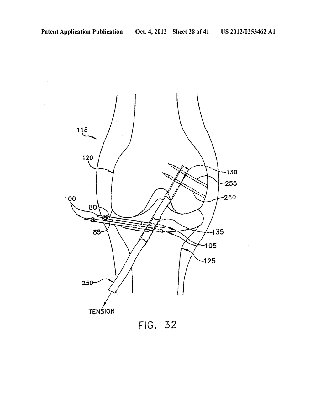 METHOD AND APPARATUS FOR FIXING A GRAFT IN A BONE TUNNEL - diagram, schematic, and image 29