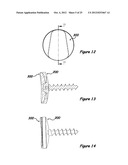 Shoulder Arthroplasty Systems and Configurations for Components Thereof diagram and image